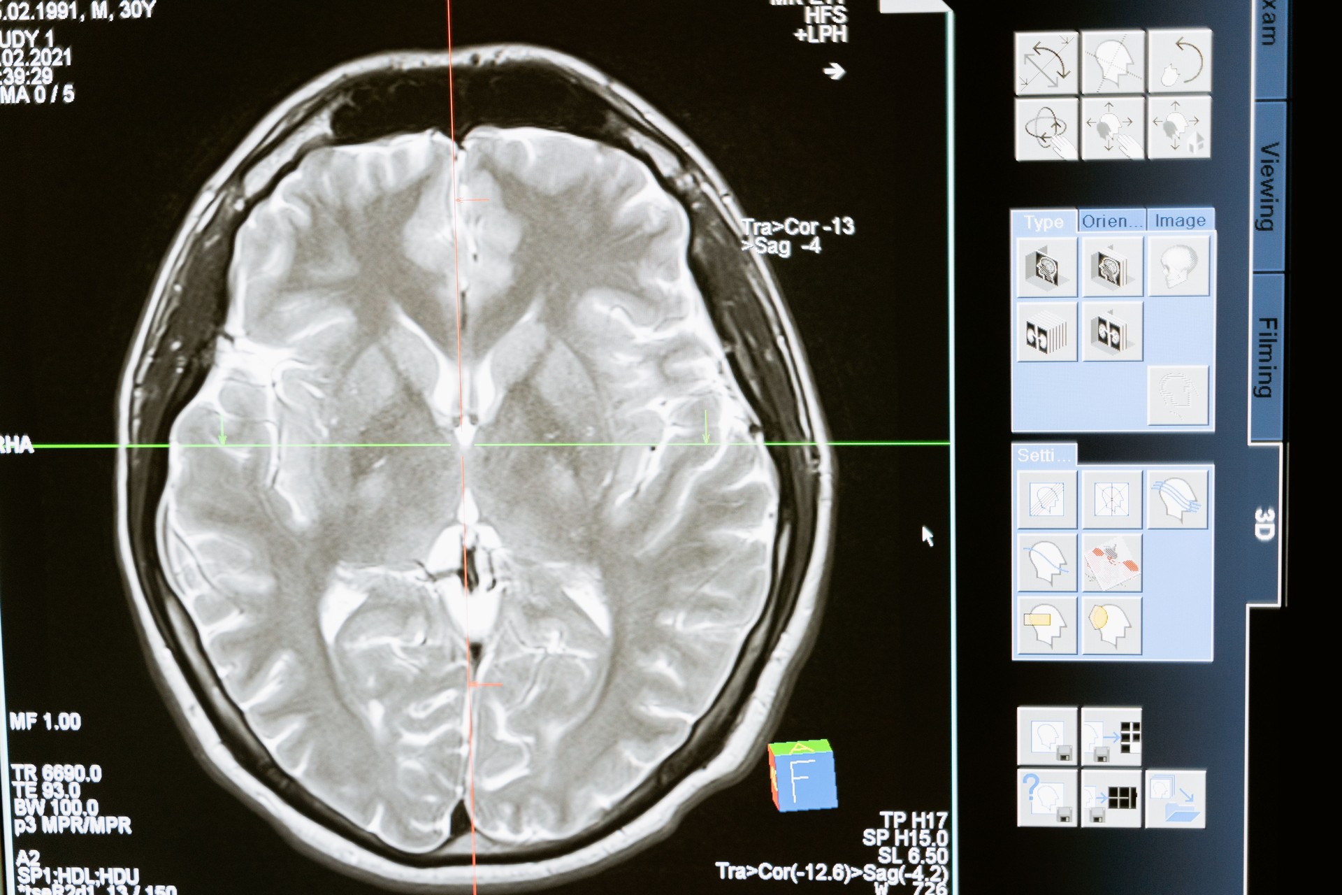 Detalle de una pantalla mostrando algoritmos de Inteligencia Artificial analizando un escaneo cerebral o datos genómicos, rep